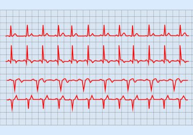 EKG grafiği, grafik Elektrokardiyogram kalp kağıt form üzerindeki