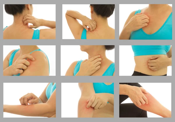 Ασθένειες Του Δέρματος Γυναίκες Που Χρησιμοποιούν Χέρι Ξύσιμο Συλλογή Roy — Φωτογραφία Αρχείου