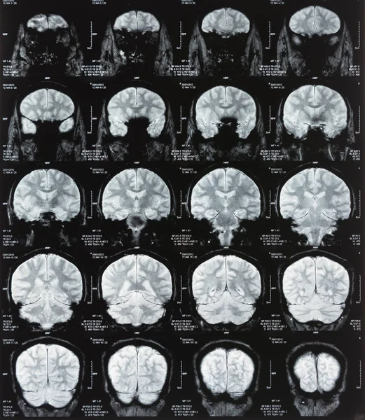 Escaneamento cerebral — Fotografia de Stock