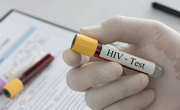 HIV testi — Stok fotoğraf