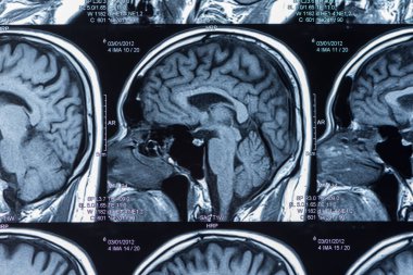 Bilgisayar tomografisi ile beynin MRI taraması.
