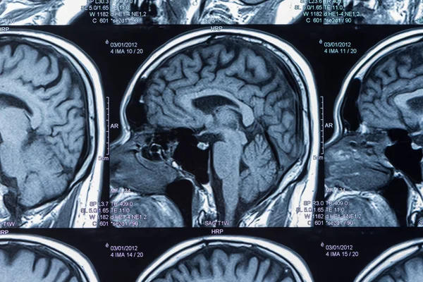 Tomografía Computarizada Por Resonancia Magnética Del Cerebro —  Fotos de Stock