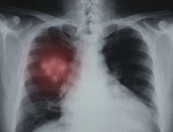 Akciğer Kanseri Akciğer Hastalığının Röntgen Görüntüsü — Stok fotoğraf