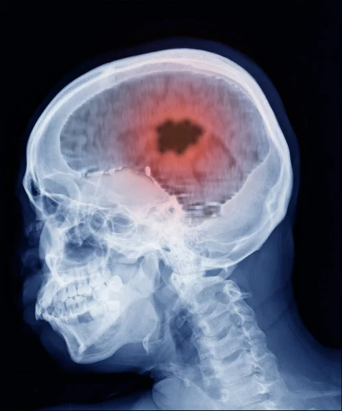 Irm Scanner Cerveau Montrant Résultat Cancer Cerveau Abcès Cérébral — Photo