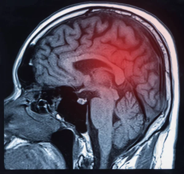 Ressonância Magnética Cérebro Mostrando Resultado Hemorragia Intracerebral Cérebro Hic — Fotografia de Stock