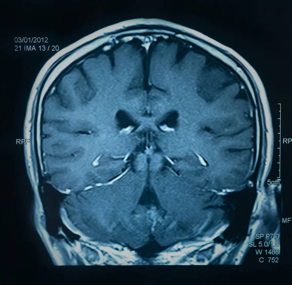 Imagem Ressonância Magnética Ressonância Magnética Cérebro — Fotografia de Stock