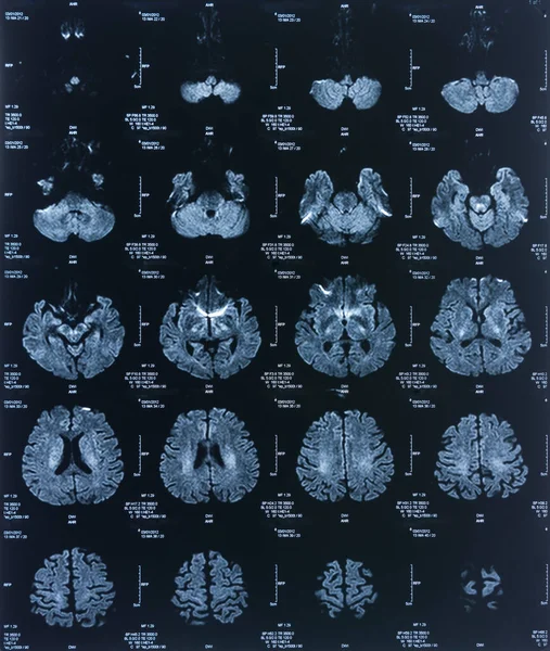 Image Radiographique Cerveau Patient Par Tomodensitométrie Pour Diagnostic Médical — Photo