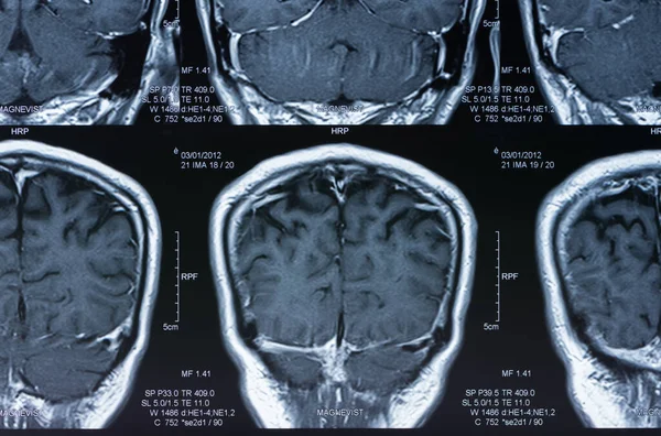 Image Par Résonance Magnétique Balayage Irm Cerveau — Photo