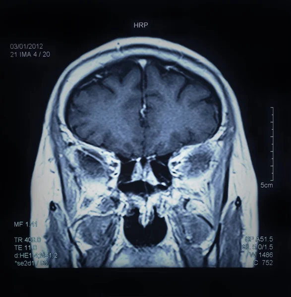 Magnetická Rezonance Mri Scan Mozku — Stock fotografie