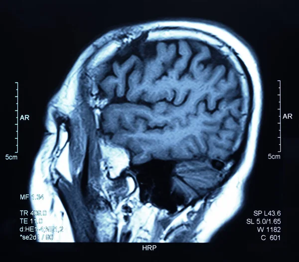 Imagem Ressonância Magnética Ressonância Magnética Cérebro — Fotografia de Stock