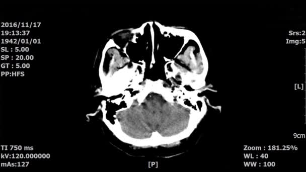 Scan Mri Computertomografie Brain Scan — Stockvideo