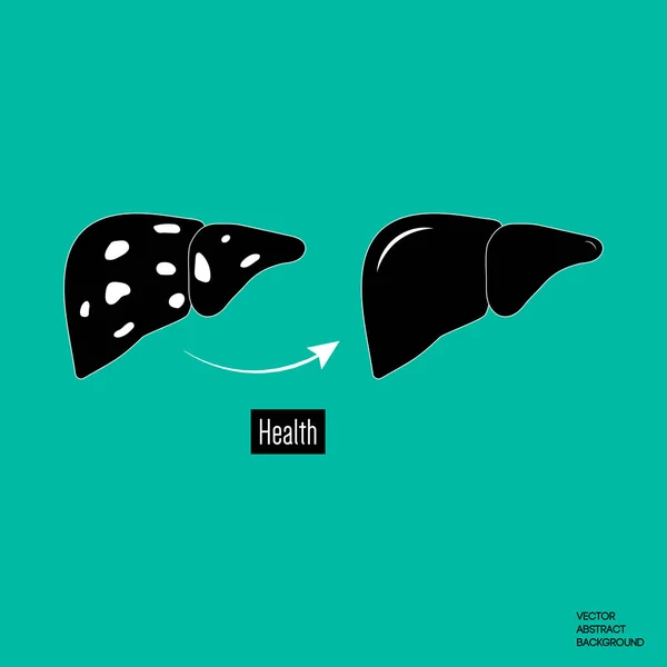 Tratamiento del hígado. Enfermedad hepática. cirrosis — Vector de stock