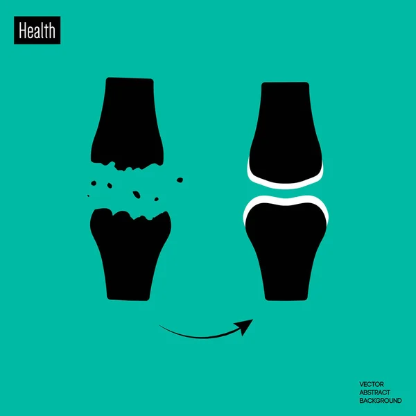 Kırık kemik. Eklem hastalığı. Kemiğin insan imha