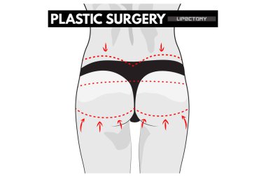 Plastik cerrahi. Vücut düzeltme.