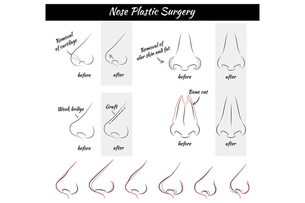 Plastik cerrahi. Burun. 