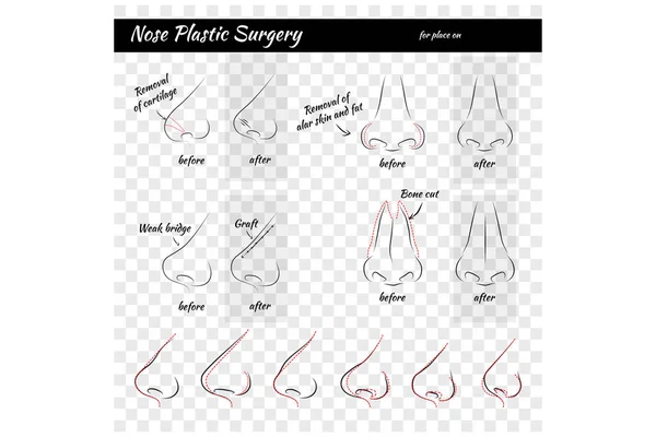 Chirurgie plastique. Nez . — Image vectorielle
