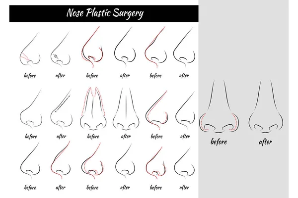 Plastische Chirurgie. Nase. — Stockvektor