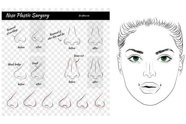 Plastische Chirurgie. Nase. — Stockvektor