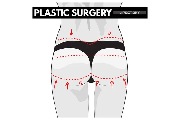 Chirurgia plastica. Correzione del corpo . — Vettoriale Stock