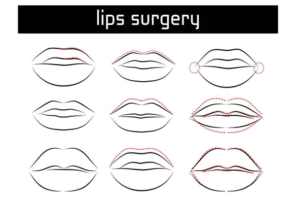 Dudak ameliyatı. Vektör çizim.