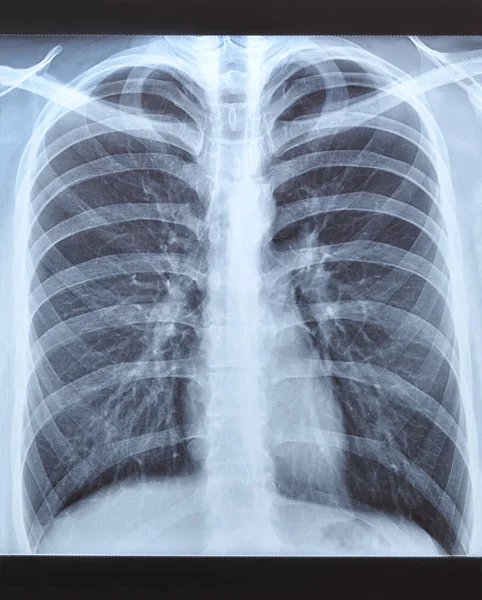 人間の肺のショットを x 線します。. — ストック写真