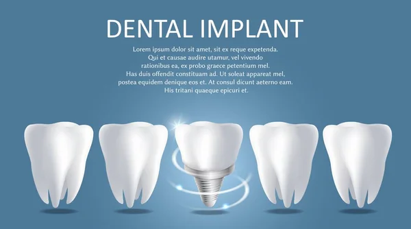 Mall för medicinsk affisch för implantatvektor för tandimplantat — Stock vektor