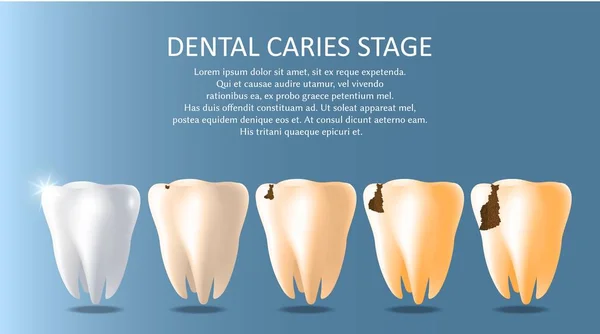 Dental caries stages vector medical poster banner template — Stock Vector