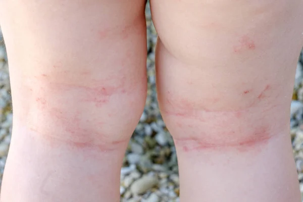 Skin irritation newborn closeup atopic dermatitis legs scratches — Stock Photo, Image