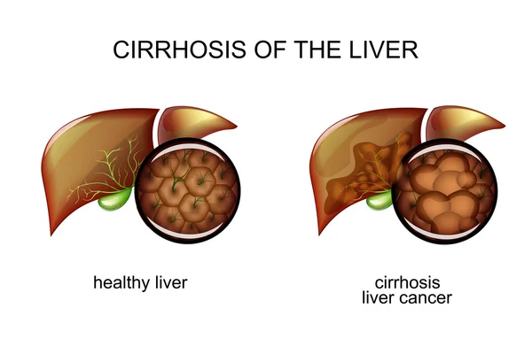 El hígado sano y el paciente con cirrosis — Archivo Imágenes Vectoriales