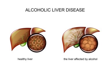alkolik karaciğer hastalığı