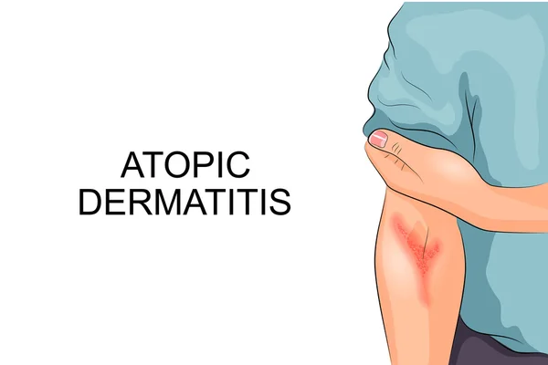 Atopická dermatitida. Alergie — Stockový vektor