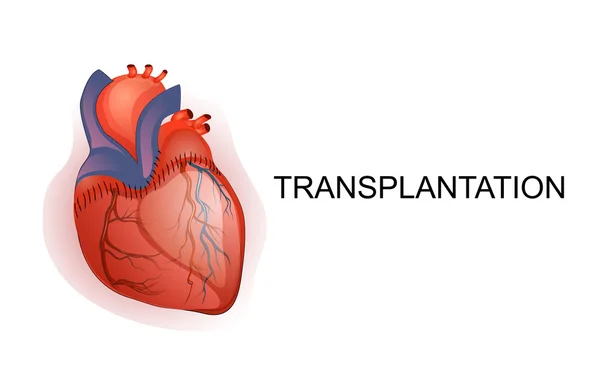 Transplantation d'organe. Coeur — Image vectorielle