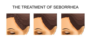 the treatment of seborrhea. before and after clipart