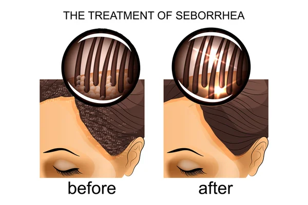 A kezelés a fejbőr seborrhea. előtt és után — Stock Vector