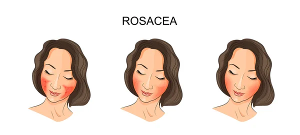 여자의 얼굴, rosacea — 스톡 벡터