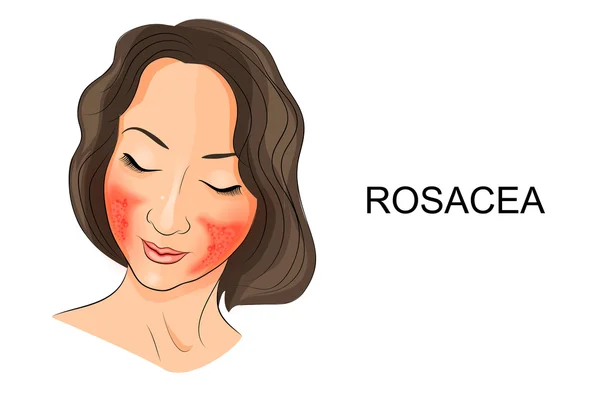 Rosácea en la cara de la chica. Dermatología — Vector de stock