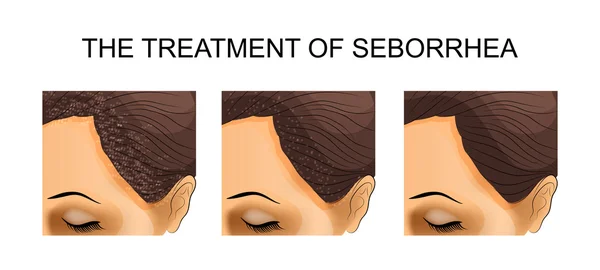 The treatment of seborrhea. before and after — Stock Vector