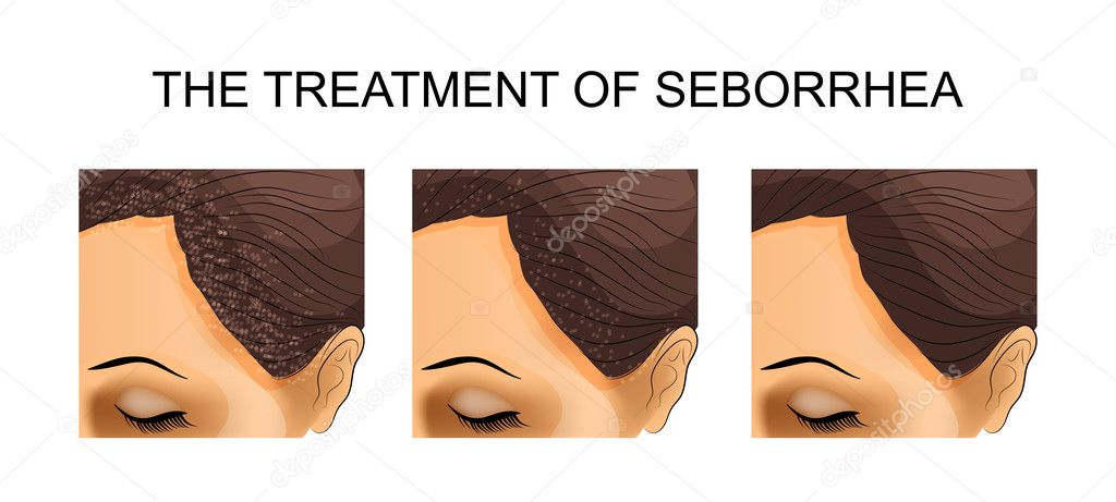 the treatment of seborrhea. before and after