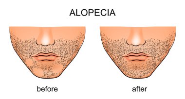 alopesi areata erkek çene üzerinde