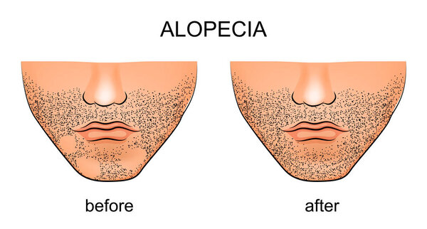 alopecia areata on the male chin