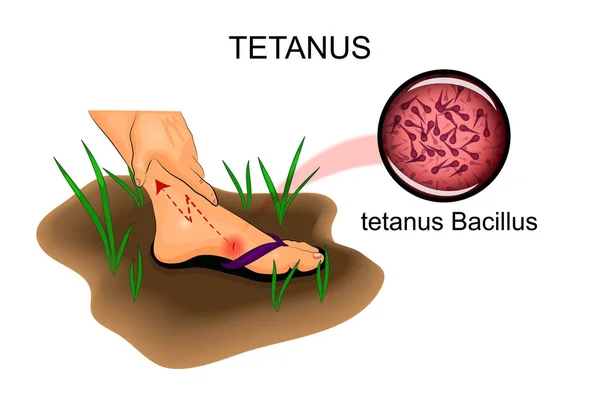 Daños en los pies. el riesgo de tétanos — Vector de stock