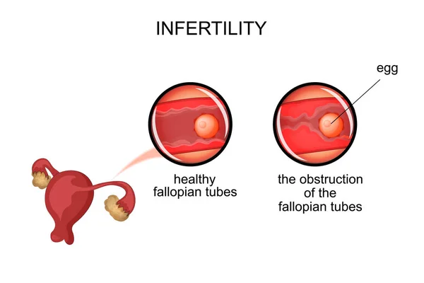 Uterus.infertility devido à obstrução das trompas de falópio —  Vetores de Stock