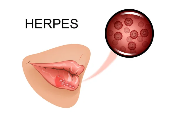 Infección en los labios de una mujer — Vector de stock