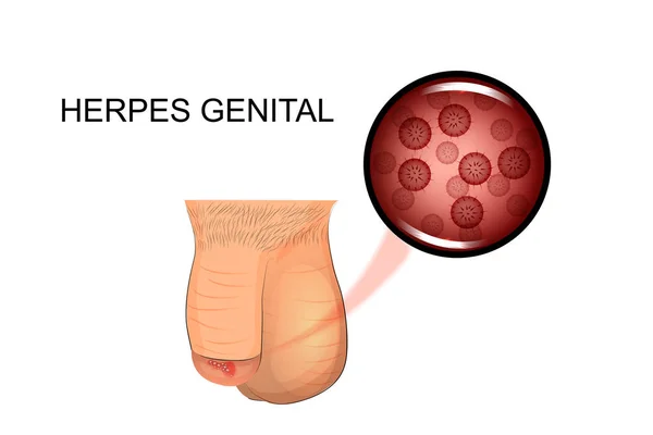 Пенис. сексуальные инфекции — стоковый вектор