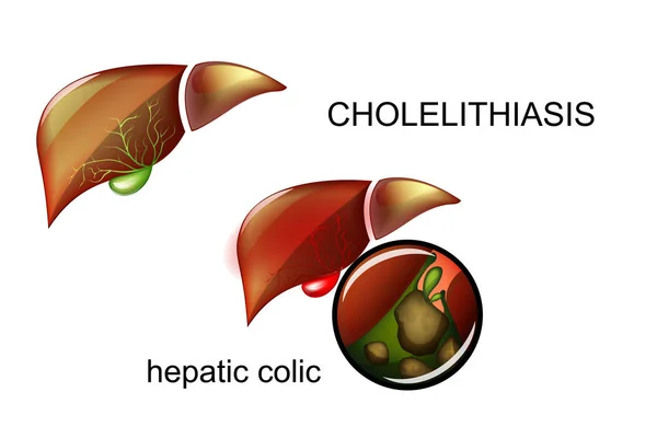 Cholelithiasis. Stones in the gallbladder. — Stock Vector