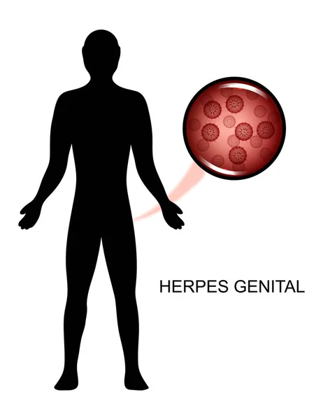 Virus genital herpes in humans — Stock Vector