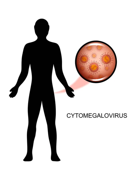 Una persona affetta da citomegalovirus — Vettoriale Stock