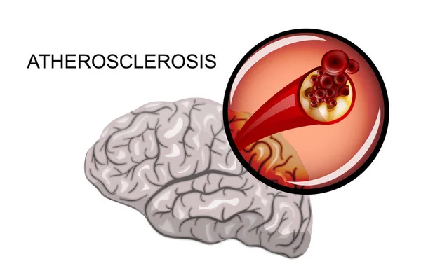 Aterosclerosis de los vasos cerebrales — Vector de stock