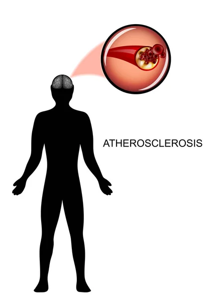 Aterosclerose dos vasos cerebrais — Vetor de Stock