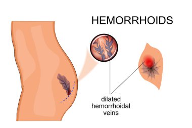 genişlemiş damarlar hemoroid